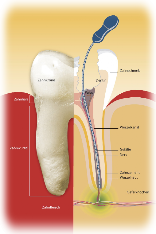 Querschnitt vom Zahn mit einer gefüllten Wurzel